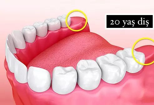 20'lik Diş Belirtileri ve Ameliyatı
