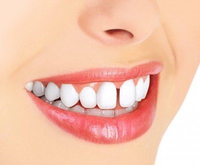 Ayrık Diş (Diastema) Tedavisi