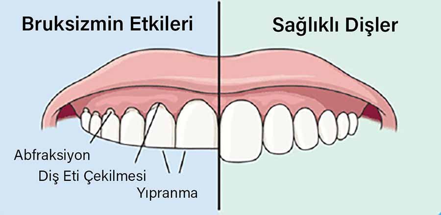 Bruksizm Nedir?
