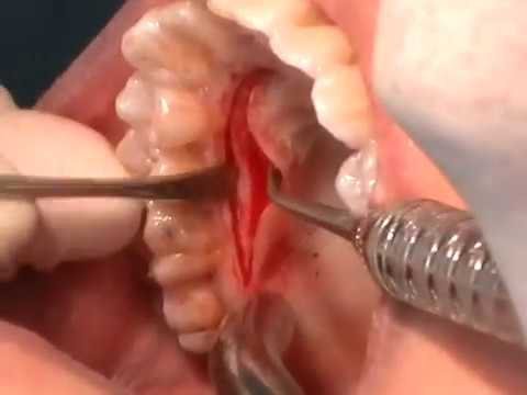 Damaktan Et Alıp Diş Eti Yapmak