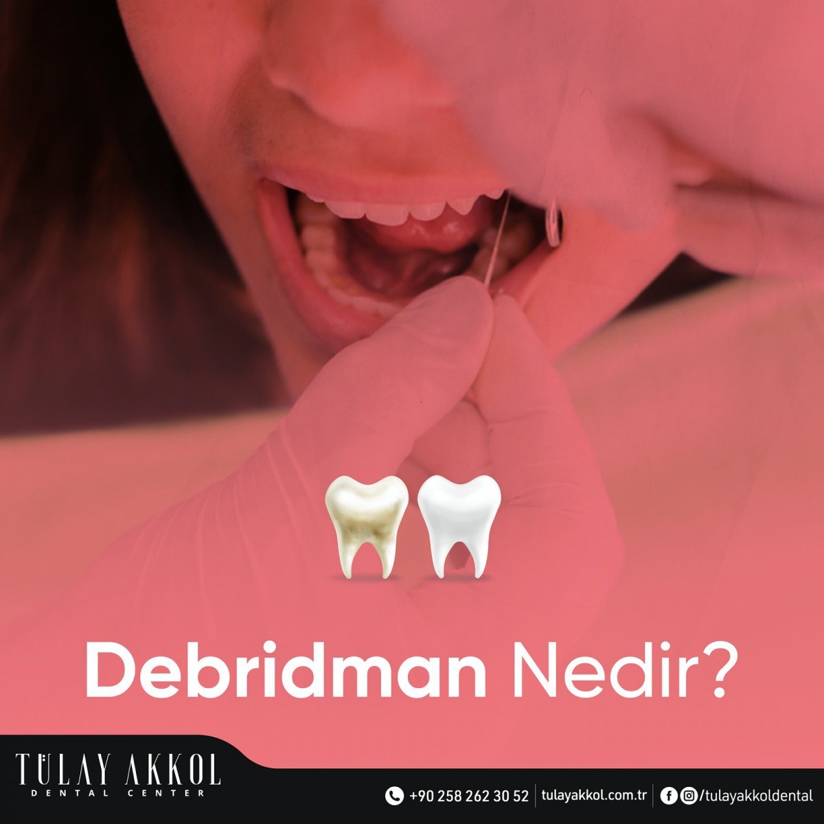 Debridman Nedir?