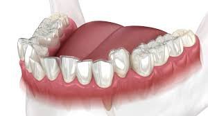 Invisalign Şeffaf Plak Tedavisini Diğerlerinden Farkı?