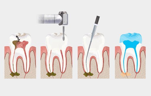 Kanal Tedavisi Nedir?