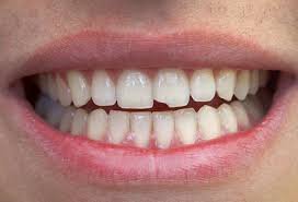 Kırılan Dişin Kökü Kalırsa Ne Olur?